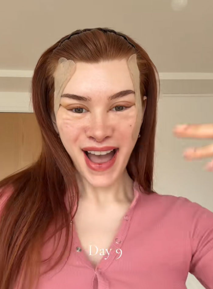 A woman with red hair and a pink shirt, showing facial bandages after a facelift. She is smiling, revealing 