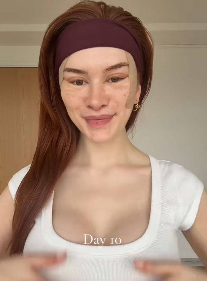 A young woman with auburn hair wearing a headband and white top, showing a post-facelift recovery with tape on her face.