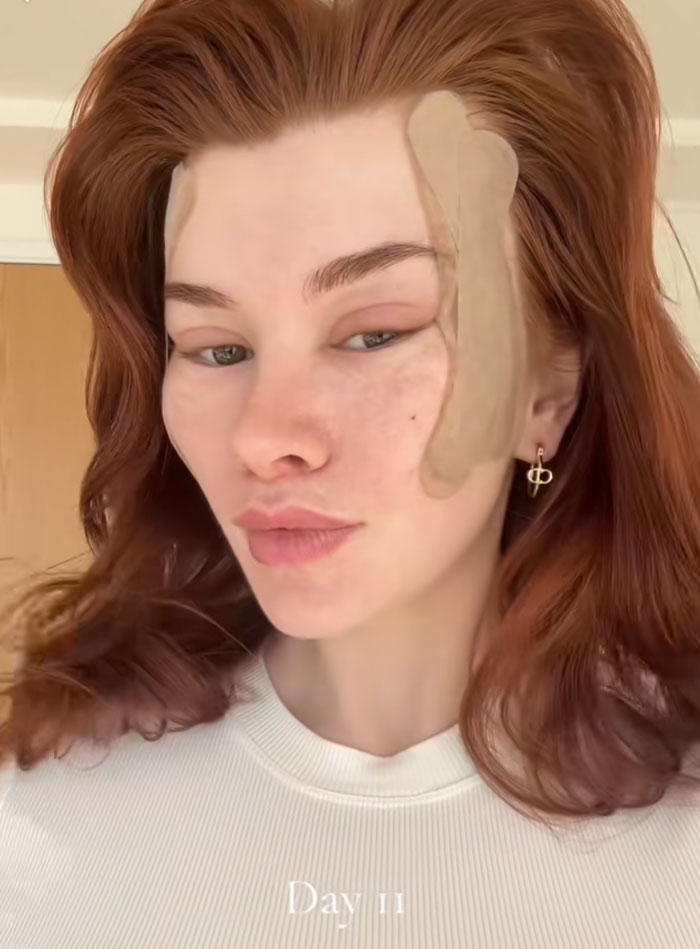 A young woman with red hair and a white shirt shows tape on her face, sparking a debate on society's new normal and facelift trends.