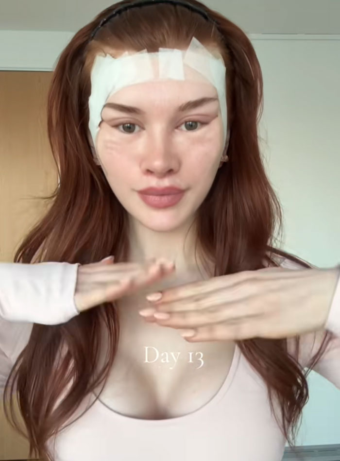 A 28YO woman with bandages from her facelift on her forehead and eyes, Day 13 post-surgery. People question society's new normal.