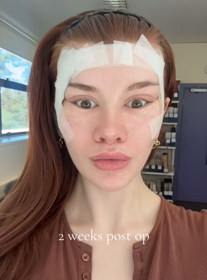 A woman with long red hair, gauze taped to her temples, two weeks post-op from a facelift, staring wide-eyed.