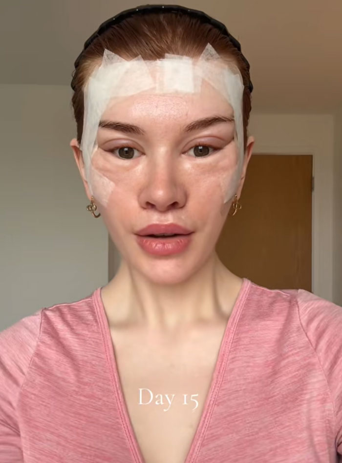 Young woman with bandages and swelling on her face, post-facelift, sparking debate on society's new normal. Day 15.