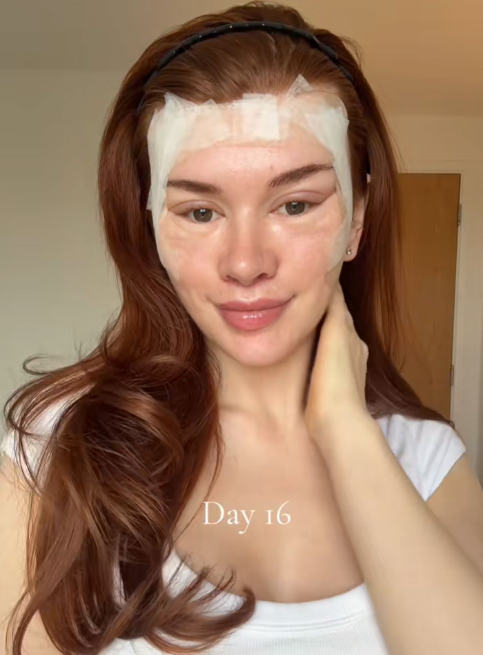 A young woman with red hair and a headband smiles at the camera, showing tape on her face 16 days after a facelift.
