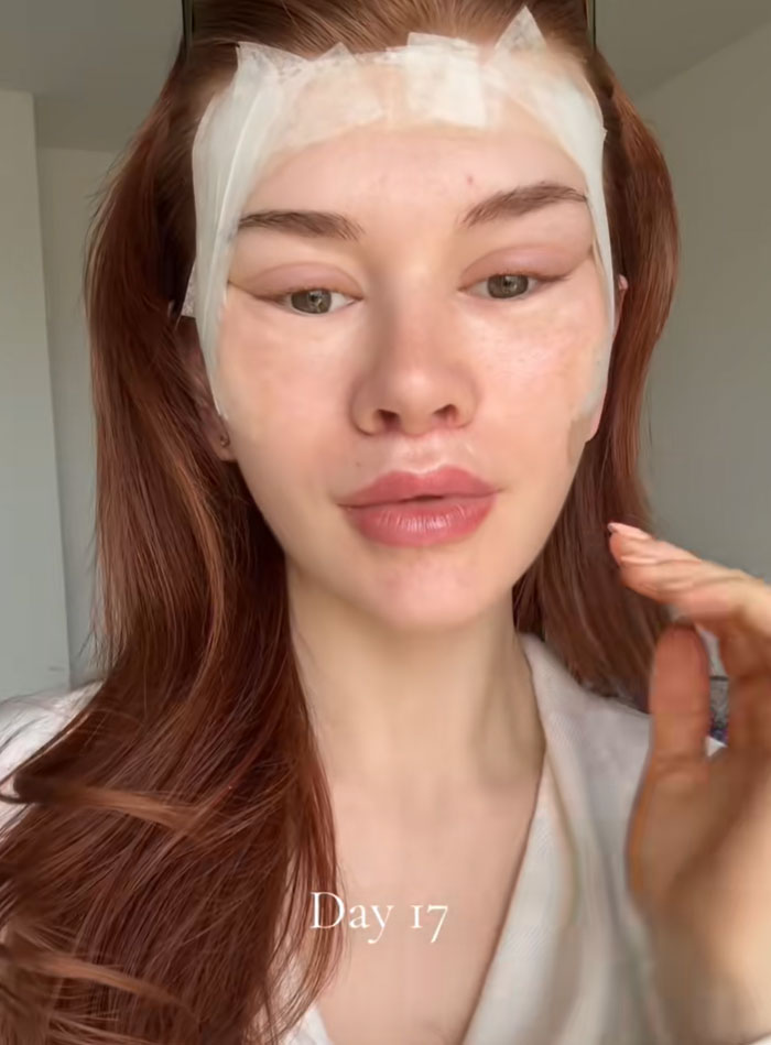 Woman with red hair and bandages on her face on Day 17 of a facelift recovery, showing a sad expression.