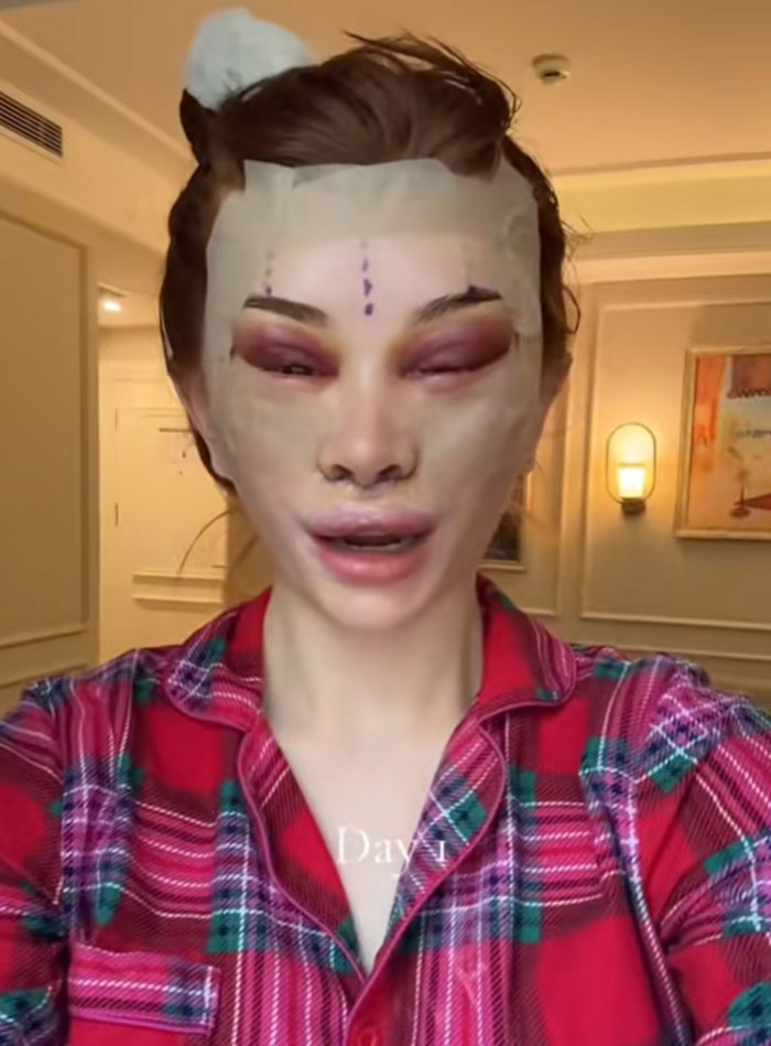 A young woman in a red plaid shirt with a bandaged face and swollen eyes post-facelift, sparking debate about society’s new normal.