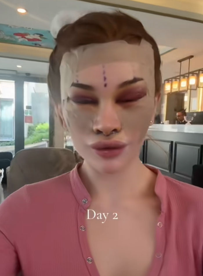 Woman with bandages and surgical markings on her face, red eyelids and lips. A facelift sparks debate. Day 2.