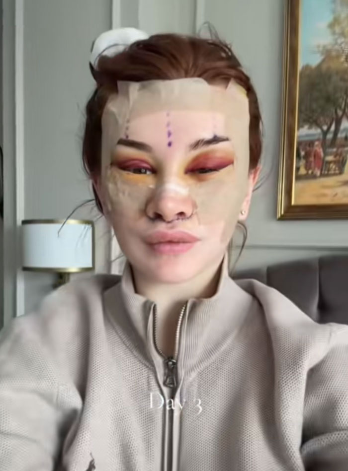 A woman with bandages and makeup after a facelift, sparking debate about society's new normal and beauty standards.