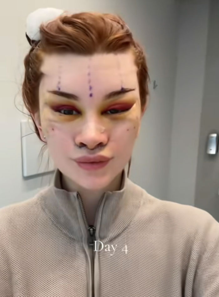 A woman with red hair, swollen eyes and purple surgical markings on her face four days post facelift.