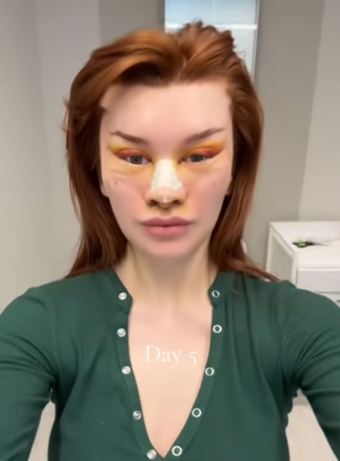 A woman with red hair, swollen eyes, a bandaged nose, and facial bruises five days post-facelift surgery.