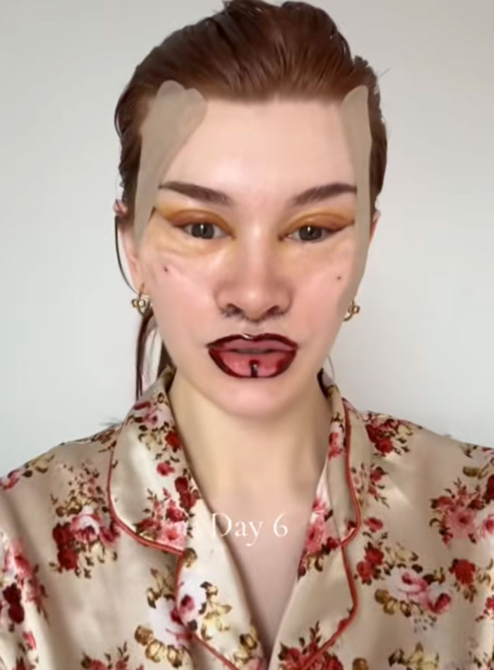 A woman post-facelift, with bandages, marked lips, and eye makeup, wearing a floral shirt, posing for an update on Day 6.