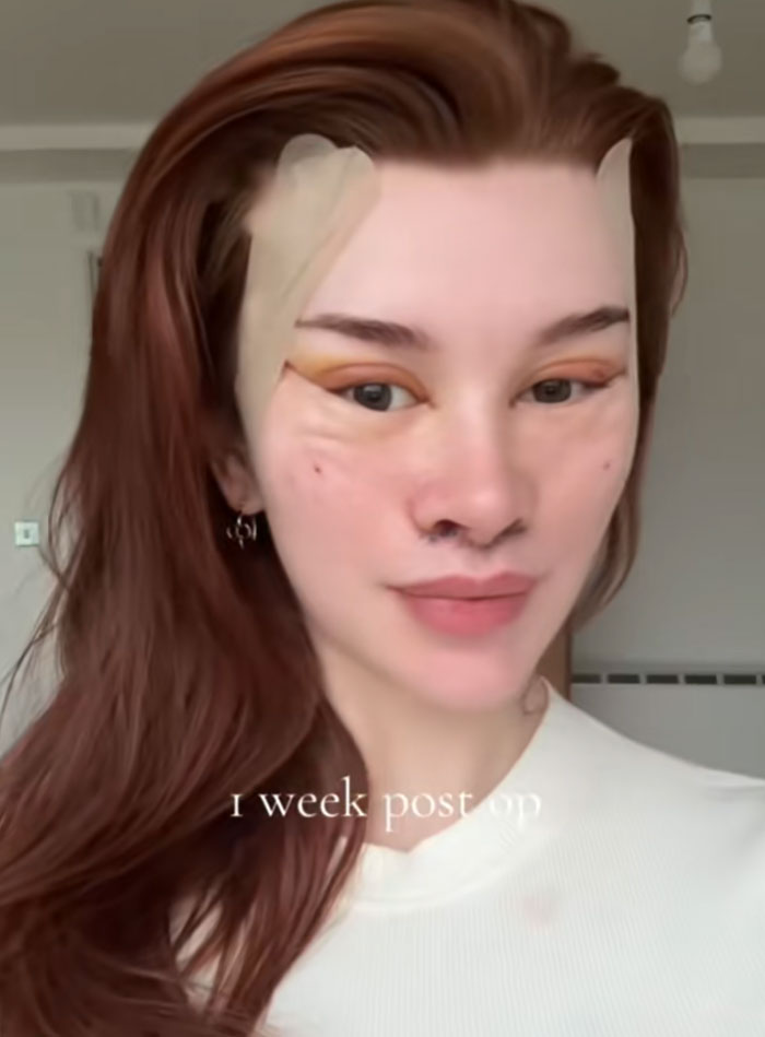 Young woman with red hair, 1 week post-op from a facelift, showing swelling and tape. A debate on society's new normal.