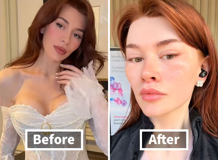 “Ridiculously Sad”: 28YO Woman’s Facelift Sparks Raging Debate As People Question Society’s New Normal