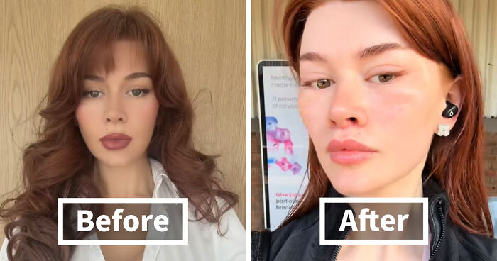 “Ridiculously Sad”: 28YO Woman’s Facelift Sparks Raging Debate As People Question Society’s New Normal