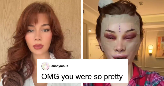 “Ridiculously Sad”: 28YO Woman’s Facelift Sparks Raging Debate As People Question Society’s New Normal