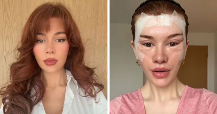 “Ridiculously Sad”: 28YO Woman’s Facelift Sparks Raging Debate As People Question Society’s New Normal