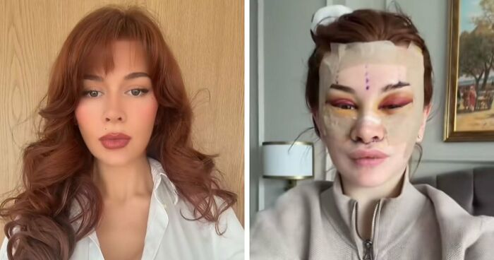“Ridiculously Sad”: 28YO Woman’s Facelift Sparks Raging Debate As People Question Society’s New Normal
