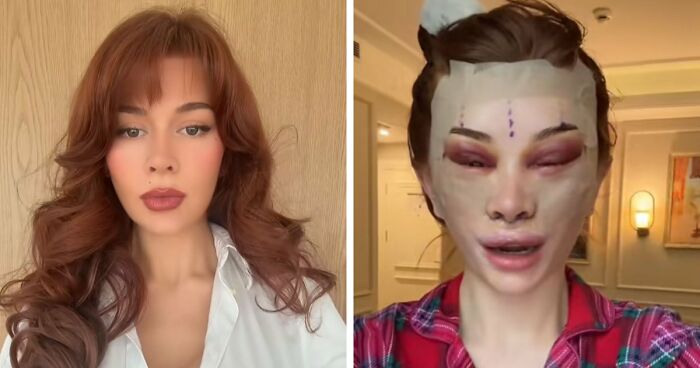 “Ridiculously Sad”: 28YO Woman’s Facelift Sparks Raging Debate As People Question Society’s New Normal