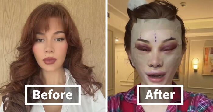“Ridiculously Sad”: 28YO Woman’s Facelift Sparks Raging Debate As People Question Society’s New Normal