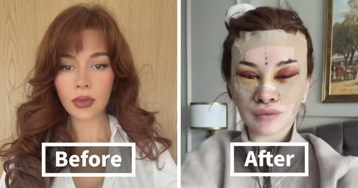 “Ridiculously Sad”: 28YO Woman’s Facelift Sparks Raging Debate As People Question Society’s New Normal