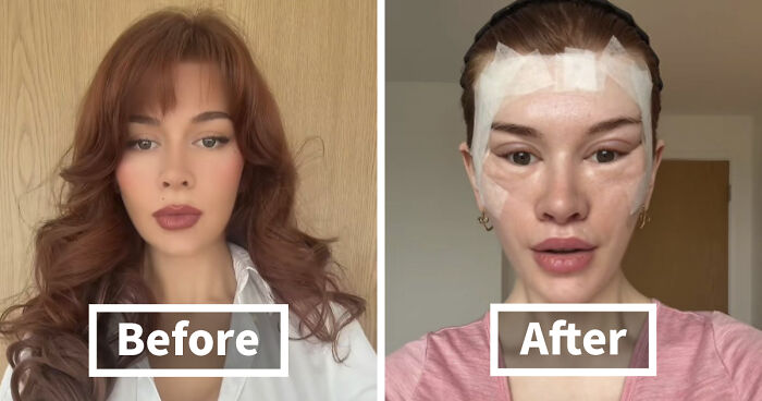 “Ridiculously Sad”: 28YO Woman’s Facelift Sparks Raging Debate As People Question Society’s New Normal