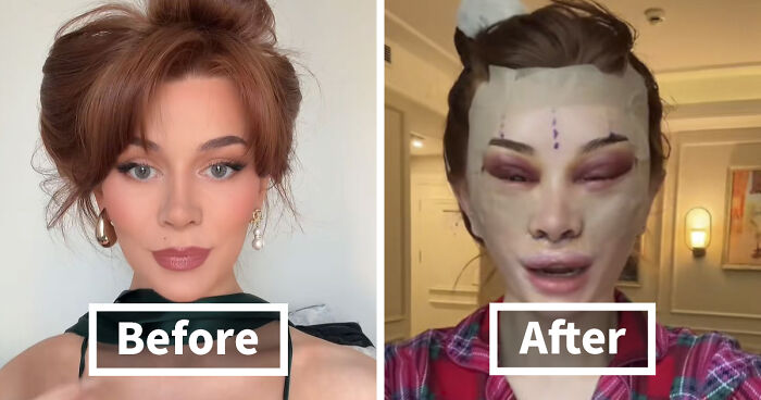 “Ridiculously Sad”: 28YO Woman’s Facelift Sparks Raging Debate As People Question Society’s New Normal