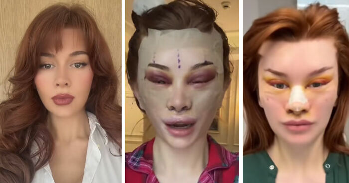 “Ridiculously Sad”: 28YO Woman’s Facelift Sparks Raging Debate As People Question Society’s New Normal