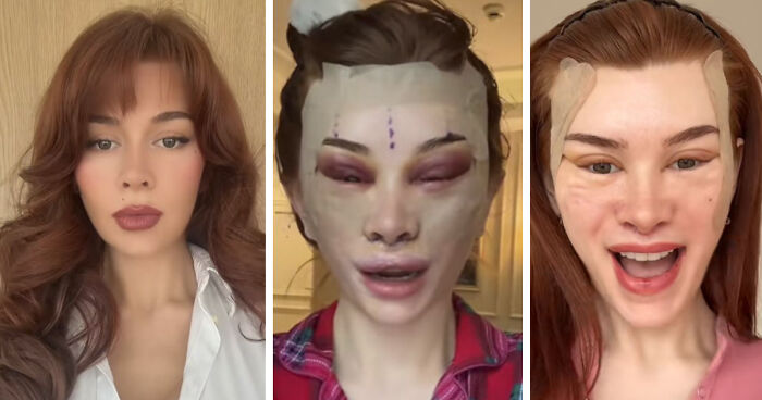 “Ridiculously Sad”: 28YO Woman’s Facelift Sparks Raging Debate As People Question Society’s New Normal