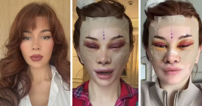 “Ridiculously Sad”: 28YO Woman’s Facelift Sparks Raging Debate As People Question Society’s New Normal