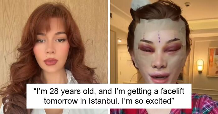 “Ridiculously Sad”: 28YO Woman’s Facelift Sparks Raging Debate As People Question Society’s New Normal