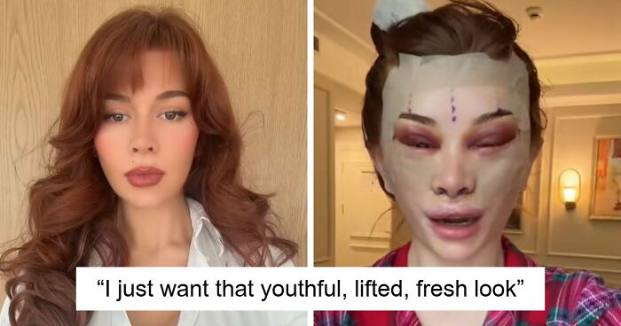 “Ridiculously Sad”: 28YO Woman’s Facelift Sparks Raging Debate As People Question Society’s New Normal