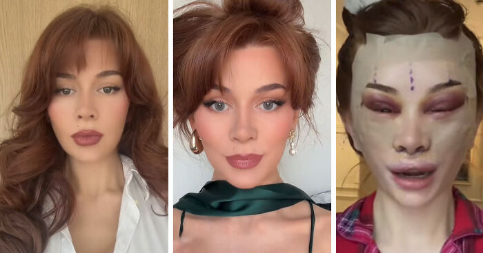 “Ridiculously Sad”: 28YO Woman’s Facelift Sparks Raging Debate As People Question Society’s New Normal