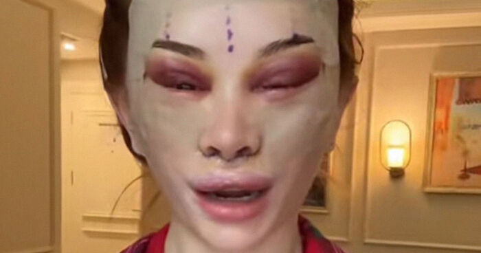 “Ridiculously Sad”: 28YO Woman’s Facelift Sparks Raging Debate As People Question Society’s New Normal