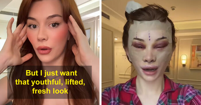 “Ridiculously Sad”: 28YO Woman’s Facelift Sparks Raging Debate As People Question Society’s New Normal