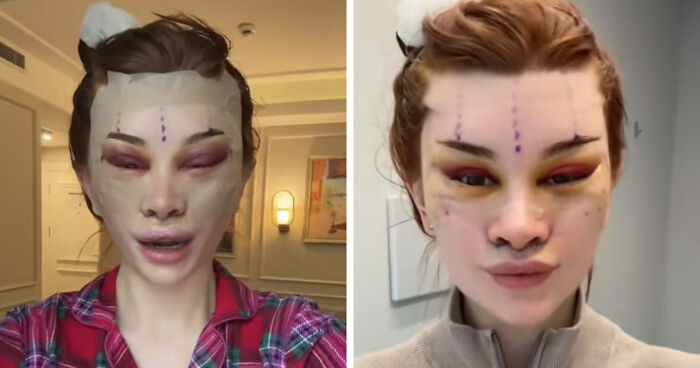 “Ridiculously Sad”: 28YO Woman’s Facelift Sparks Raging Debate As People Question Society’s New Normal