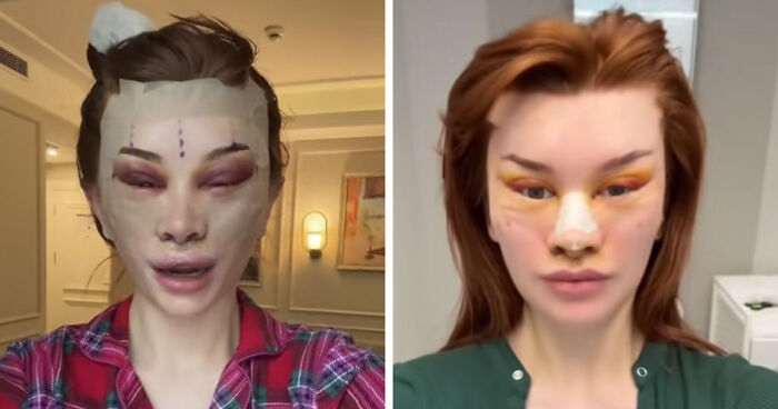 “Ridiculously Sad”: 28YO Woman’s Facelift Sparks Raging Debate As People Question Society’s New Normal