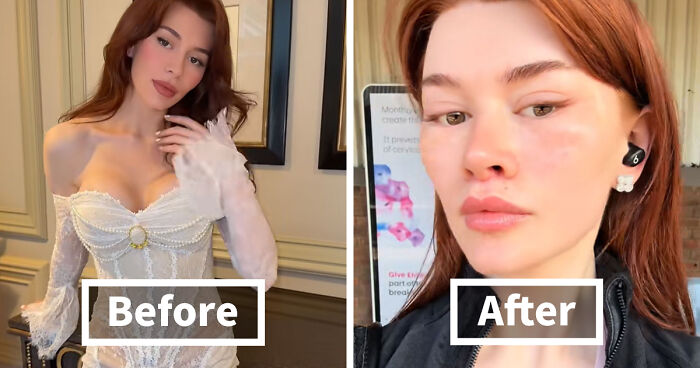 “Ridiculously Sad”: 28YO Woman’s Facelift Sparks Raging Debate As People Question Society’s New Normal
