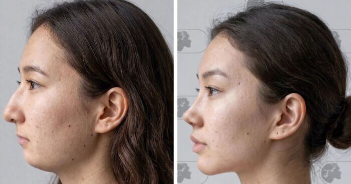 “Best Facial Harmonization I’ve Ever Seen”: 25 Before-And-Afters By A Plastic Surgeon Whose Work Went Viral