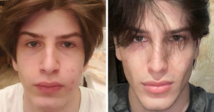 From Bone Smashing To Chin Extensions, Here Are Before-And-After Collages Of “Looksmaxxing” Influencers