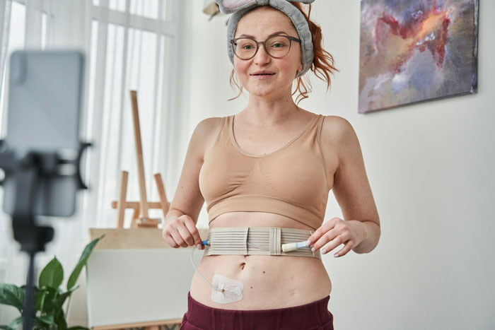 A woman with a feeding tube system around her midsection, demonstrating its use while filming. The woman relies on a feeding tube.