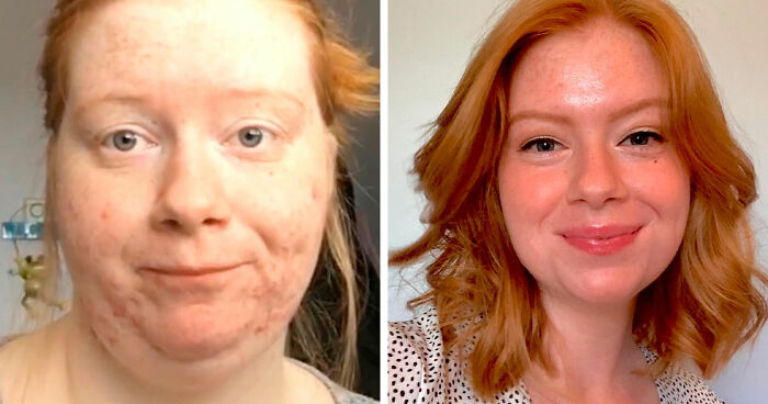 “There Is Hope”: 57 Glow-Ups So Extreme, People Barely Look Like The Same Person
