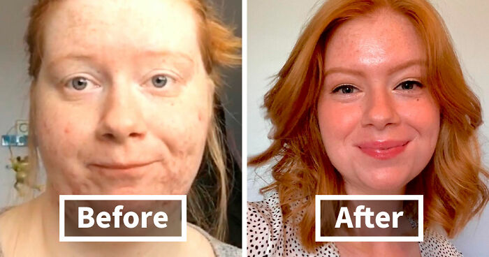 “There Is Hope”: 57 Glow-Ups So Extreme, People Barely Look Like The Same Person