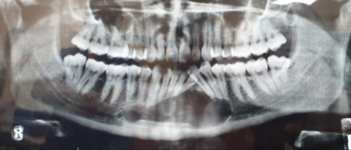 Panoramic dental X-ray showing teeth and jaw structure for a case that still feels fake but is real.