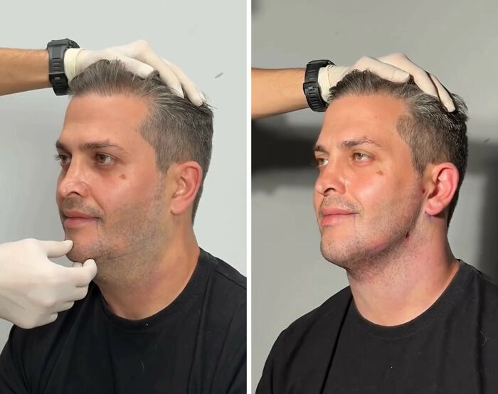 These Viral Face Transformations Look Like Something Is “Snapping” Into Place — And People Are Obsessed (21 Pics)- Interview