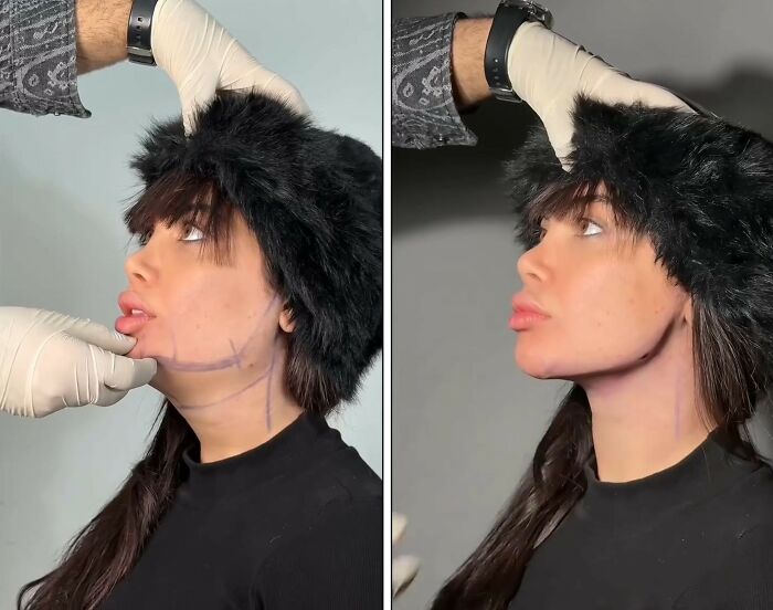 These Viral Face Transformations Look Like Something Is “Snapping” Into Place — And People Are Obsessed (21 Pics)- Interview