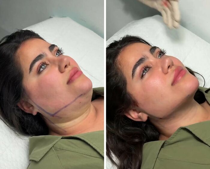These Viral Face Transformations Look Like Something Is “Snapping” Into Place — And People Are Obsessed (21 Pics)- Interview