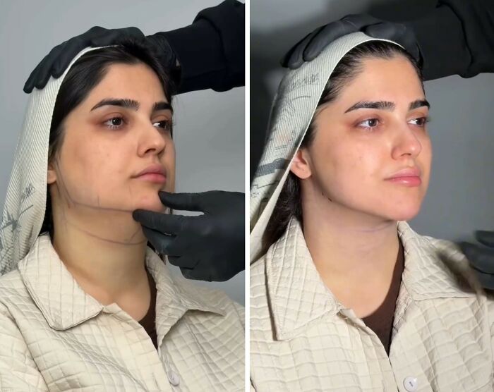 These Viral Face Transformations Look Like Something Is “Snapping” Into Place — And People Are Obsessed (21 Pics)- Interview