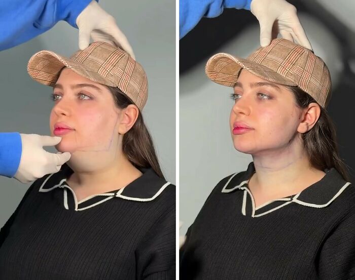 These Viral Face Transformations Look Like Something Is “Snapping” Into Place — And People Are Obsessed (21 Pics)- Interview