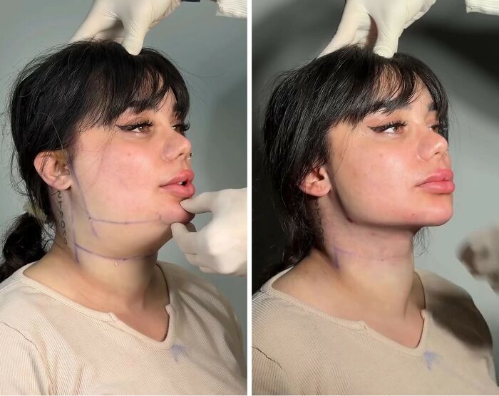 These Viral Face Transformations Look Like Something Is “Snapping” Into Place — And People Are Obsessed (21 Pics)- Interview