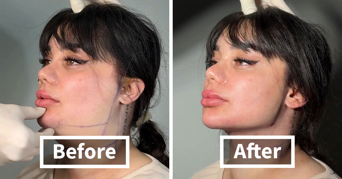 31 Impressive Jawline Transformations Shared On This Page Have People Doing A Double Take