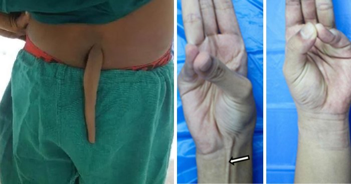 Most Of Us Walk Around Unaware Of These Bizarre Human Body Quirks – Odds Are, You Have Them Too